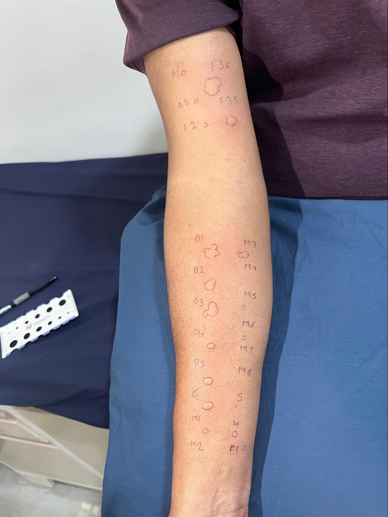 Skin prick allergy test markings mapped out on a patient's forearm